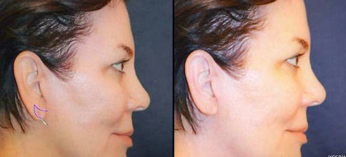 bellissimo offers earlobe reduction surgery in pittsburgh, pa