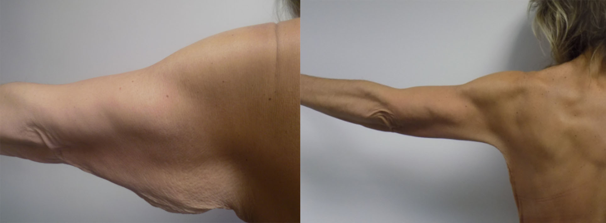 Brachioplasty (Arm Lift): Surgery, Recovery & What To Expect