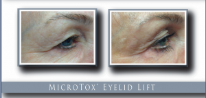 Microtox Eyelid Lift, Before and After, Bellissimo Plastic Surgery and Medi Spa
