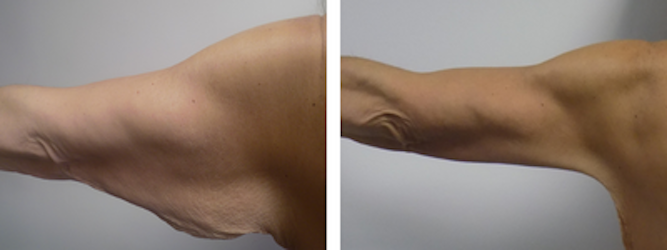 Before and After Photos, Are They Relevant?