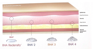 RHA Redensity Slide 1, Bellissimo Plastic Surgery and Medi Spa
