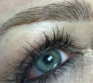Brow lift, from Bellissimo Plastic Surgery and Medi Spa